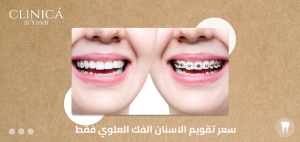 سعر تقويم الاسنان الفك العلوي فقط