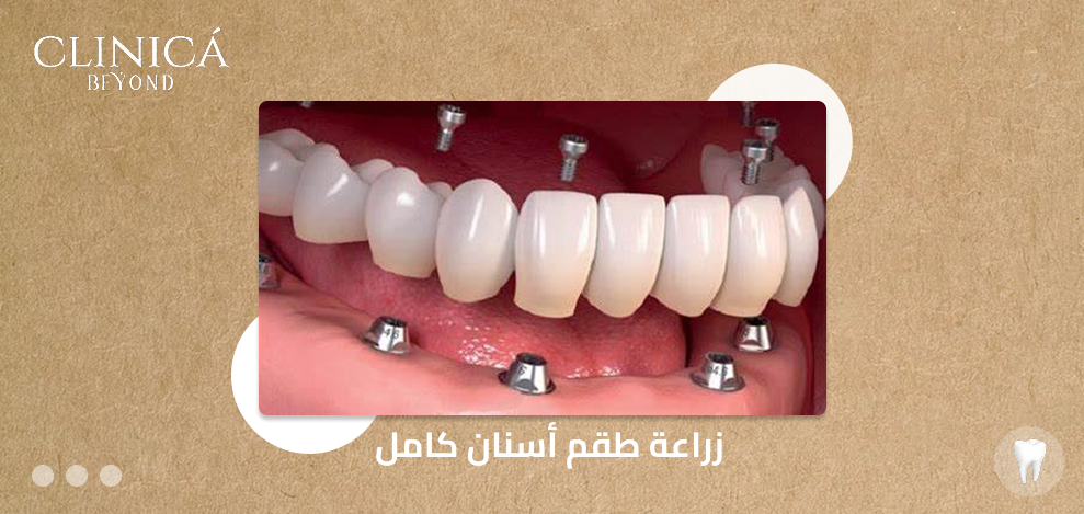 زراعة طقم أسنان كامل