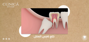 خلع ضرس العقل