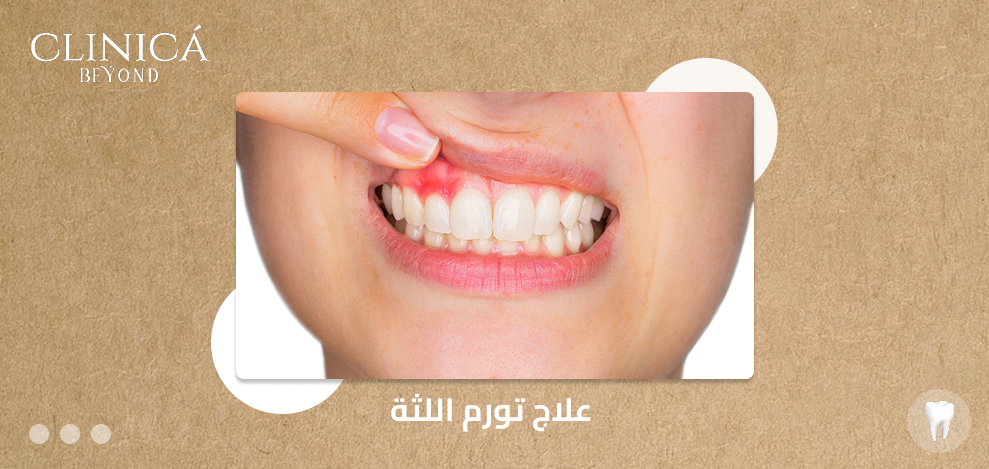 علاج تورم اللثة