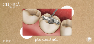 حشو العصب بكام