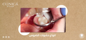 انواع حشوات الضروس