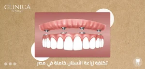 تكلفة زراعة الأسنان كاملة في مصر